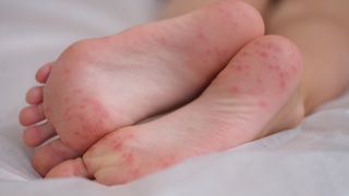 Hand foot and mouth in the rise in Central