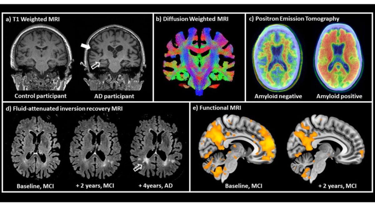 Fellowship Supports Early Dementia Research