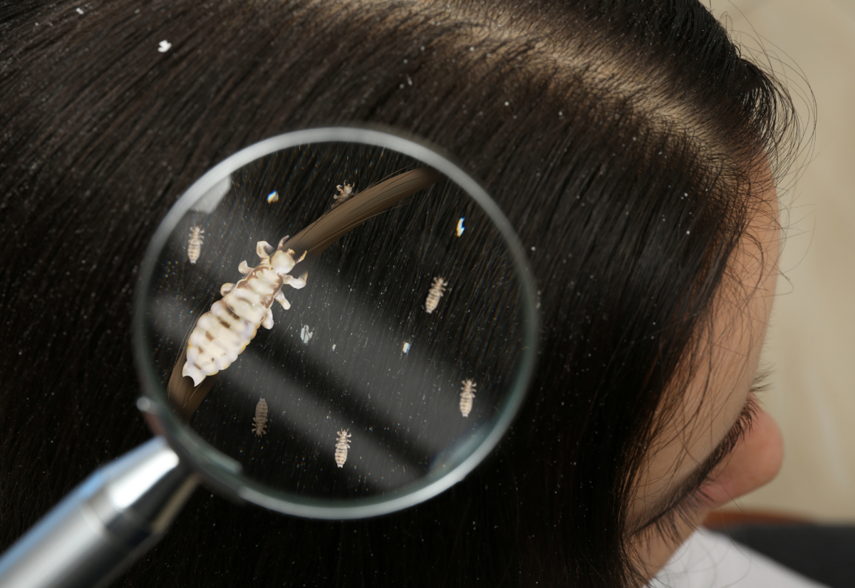 The Nitty-Gritty Head Lice