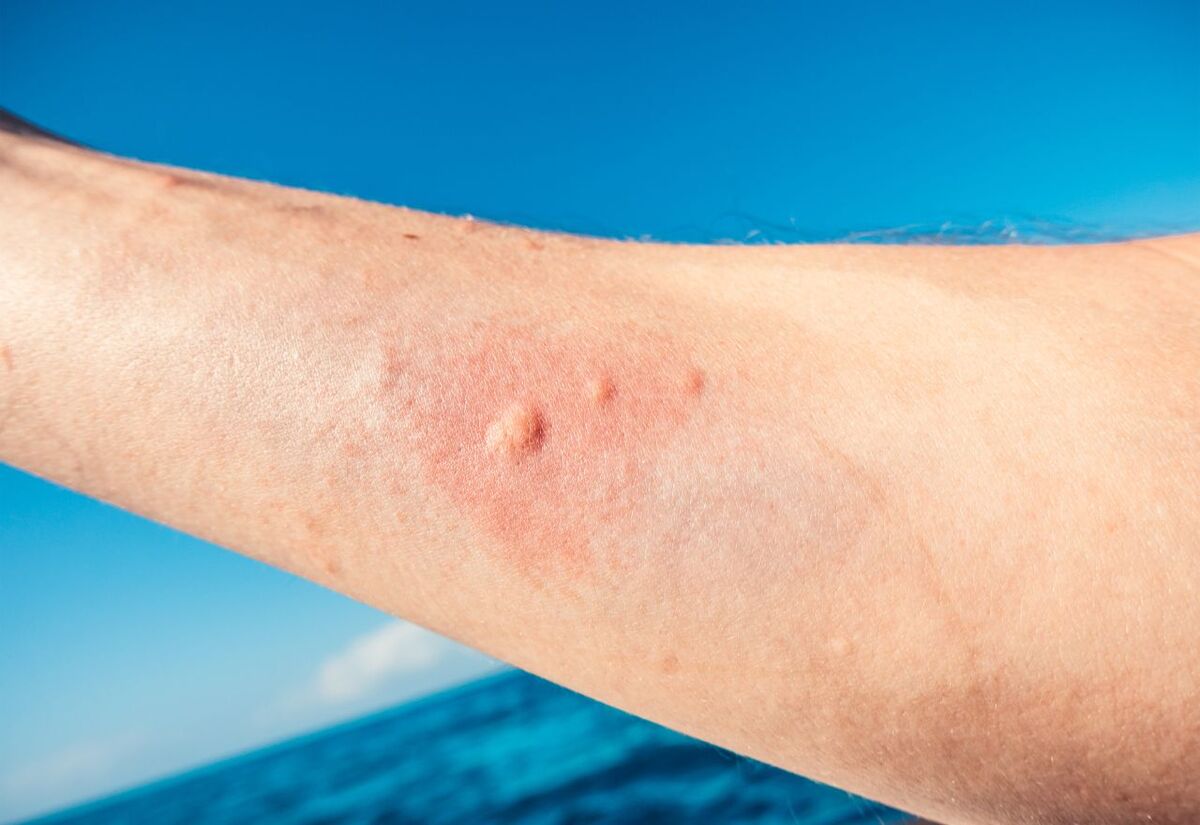 Orewa Beach Swimmers Warned of Itchy Rashes