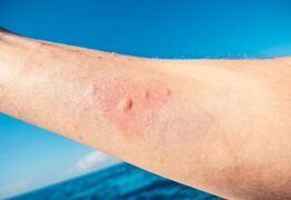 Orewa Beach Swimmers Warned of Itchy Rashes