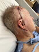 Mark Coulton undergoes melanoma surgery 