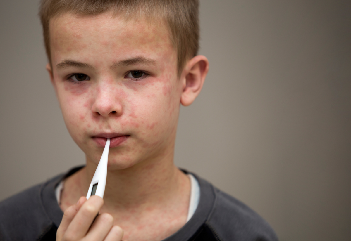 Measles alert for Byron Bay, Lennox Head and surrounds