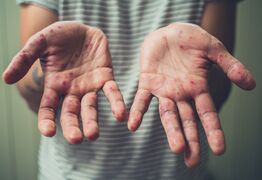 Measles Exposure Confirmed in Auckland