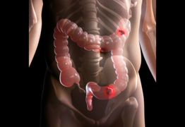 Bowel cancer rates for under 50 now highest in the world