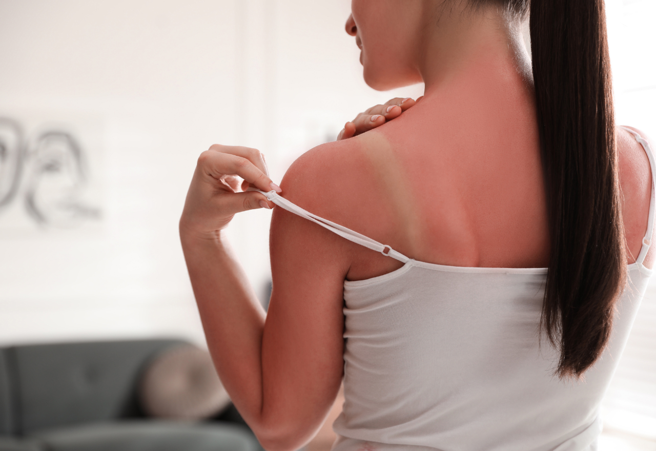 Increase in NSW adults getting sunburnt; even in winter