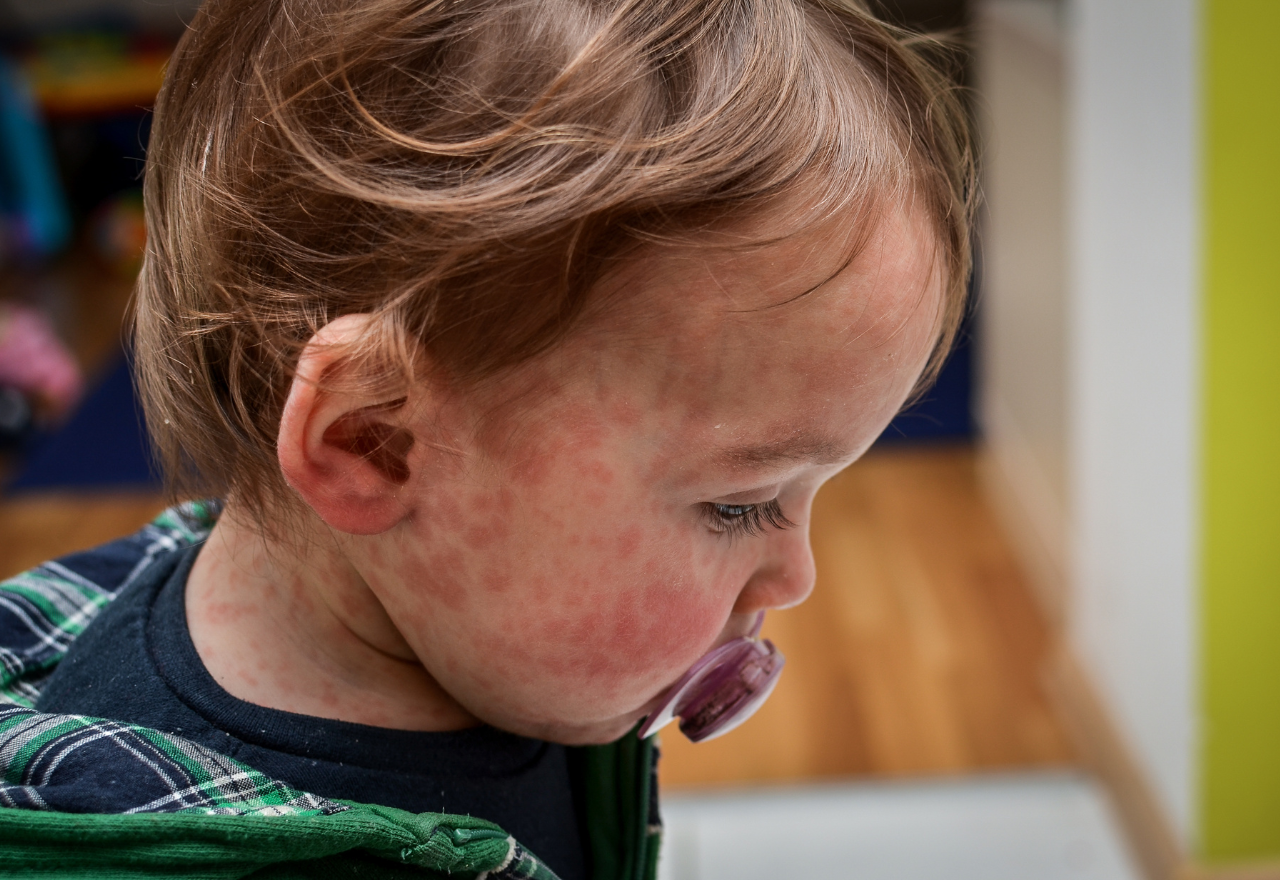 Measles alert for Lismore area